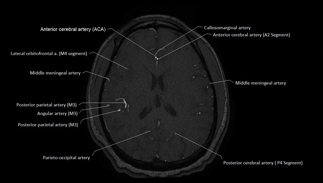 MRA brain (cerebral arteries) anatomy axial 3T image 36.webp